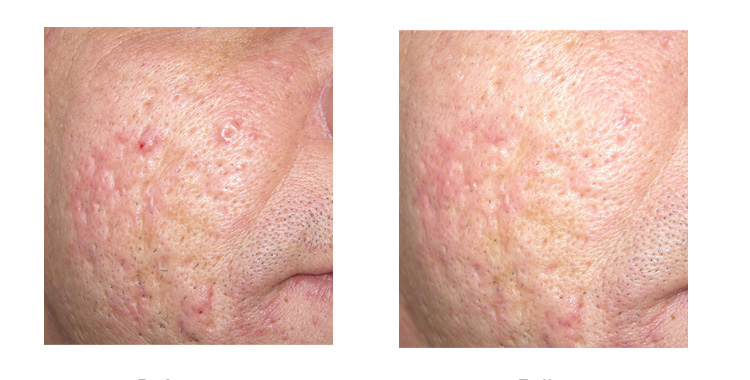 trattamento cicatrici da acne con TFL