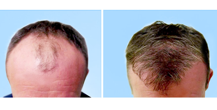 trattamento ossigeno terapia concentrata pe r la prevenzione della caduta dei capelli