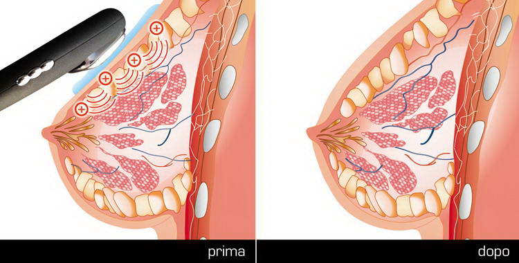 ilift firming risultati