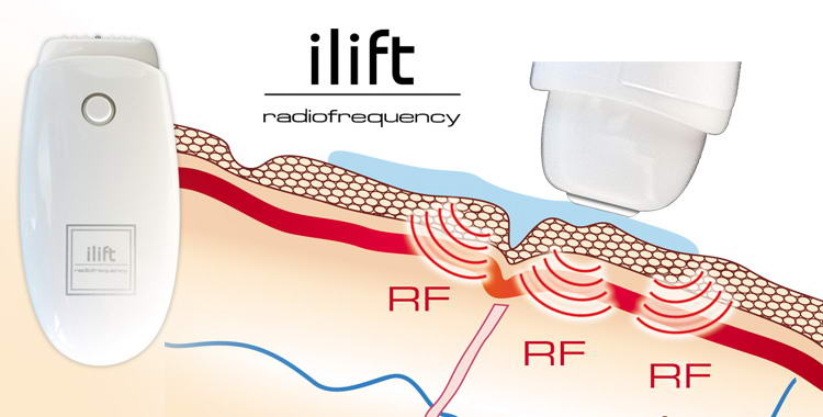 ilift radiofrequency risultati