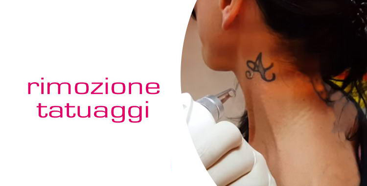 trattamento rimozione tatoo