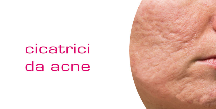 trattamento cicatrici acneiche con laser frazionato