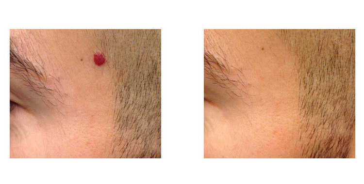 trattamento con laser blue su angioma rubino