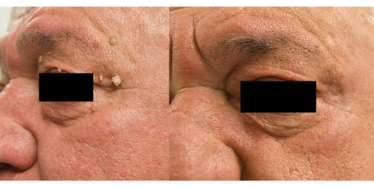 trattamento con laser blue su nevo fibroma pendulo