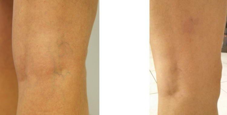 trattamento con laser blue sui capillari delle gambe