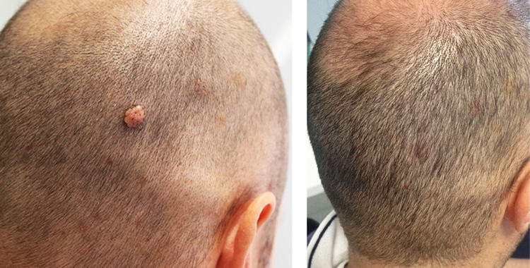 trattamento con laser blue per il dermofibroma